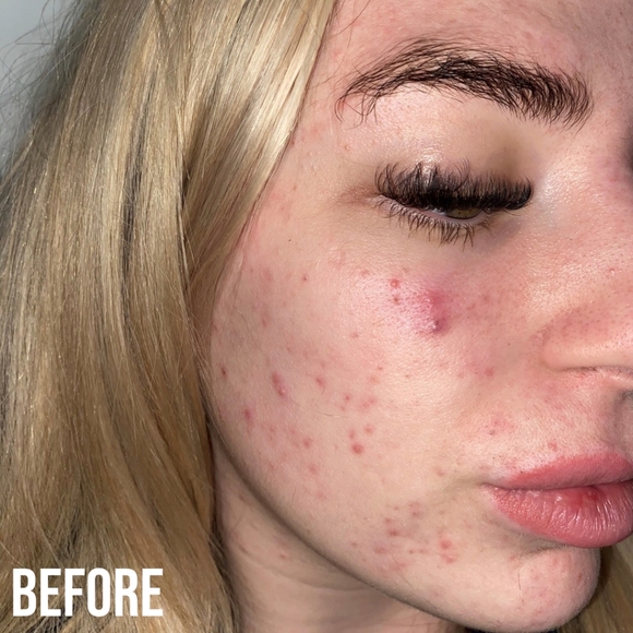 NIB! NIP+ FAB RENEW Blemish gel treatment - Picture 4 of 6